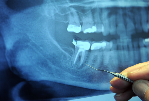 Electro-conductive & Antibacterial Material for Endodontic Treatment